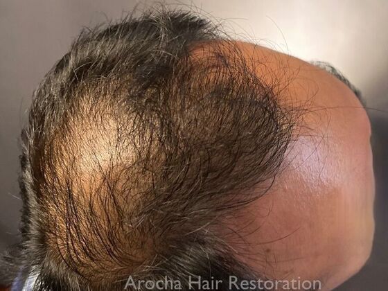 FUE Hair Restoration: Case 36 - Before