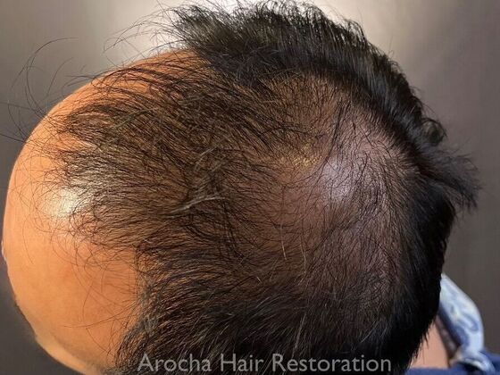 FUE Hair Restoration: Case 36 - Before