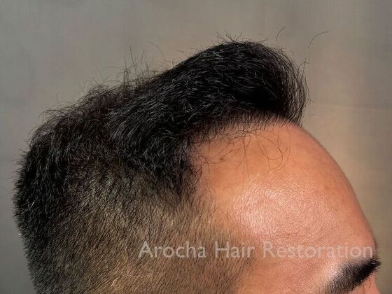 FUE Hair Restoration: Case 36 - After