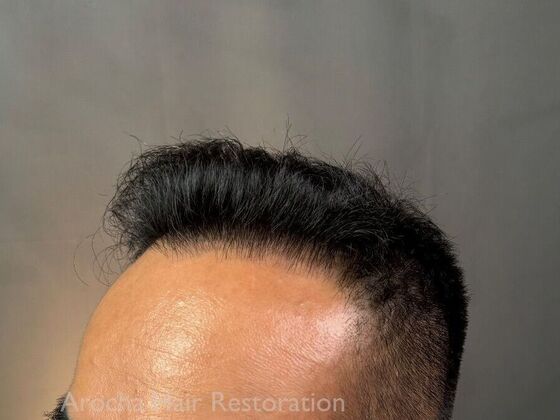 FUE Hair Restoration: Case 36 - After