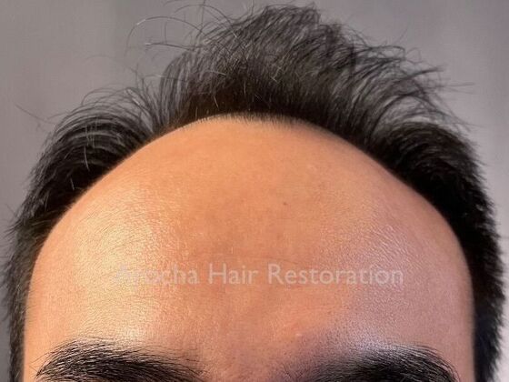 FUE Hair Restoration: Case 36 - Before
