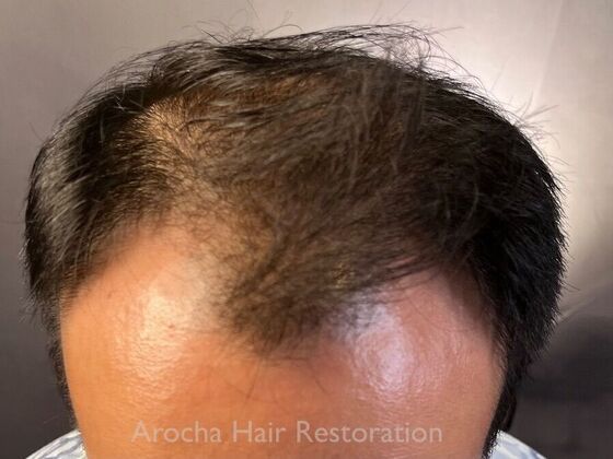 FUE Hair Restoration: Case 36 - Before