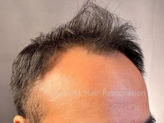 FUE Hair Restoration: Case 36 - Before