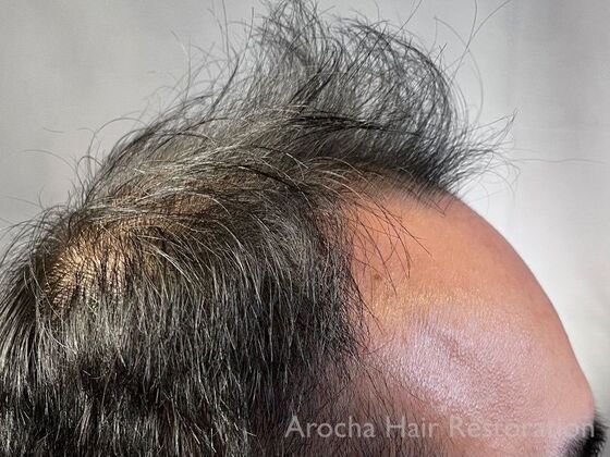 FUE Hair Restoration: Case 36 - Before