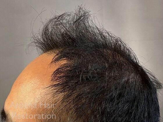 FUE Hair Restoration: Case 36 - Before