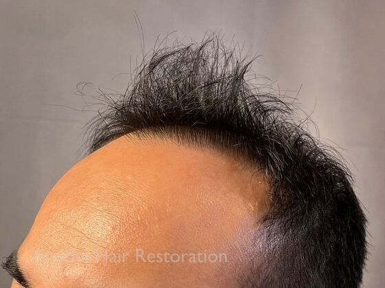 FUE Hair Restoration: Case 36 - Before