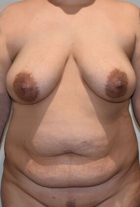 Mommy Makeover Case 306 - Before