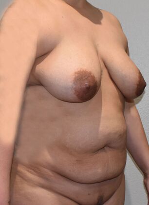 Mommy Makeover: Case 306 - Before