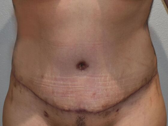 Tummy Tuck (Abdominoplasty): Case 484 - After
