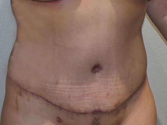 Tummy Tuck (Abdominoplasty): Case 484 - After