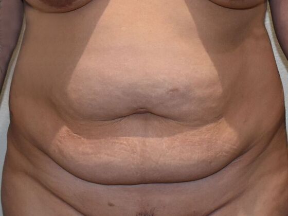 Tummy Tuck (Abdominoplasty): Case 484 - Before