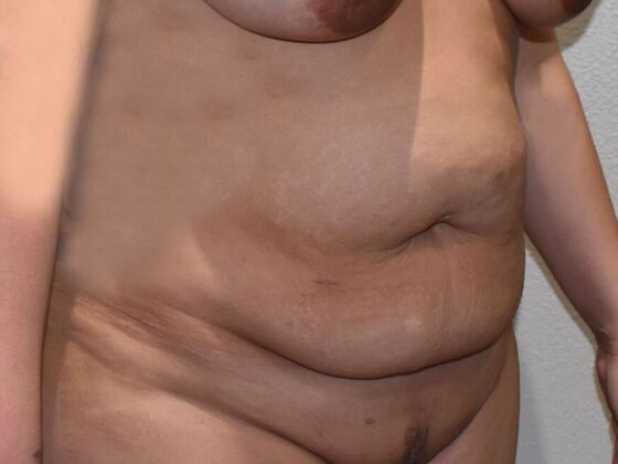 Tummy Tuck (Abdominoplasty): Case 484 - Before