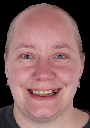 All-On-4/6: Gina Full mouth Implants - Before