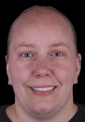 All-On-4/6: Gina Full mouth Implants - After