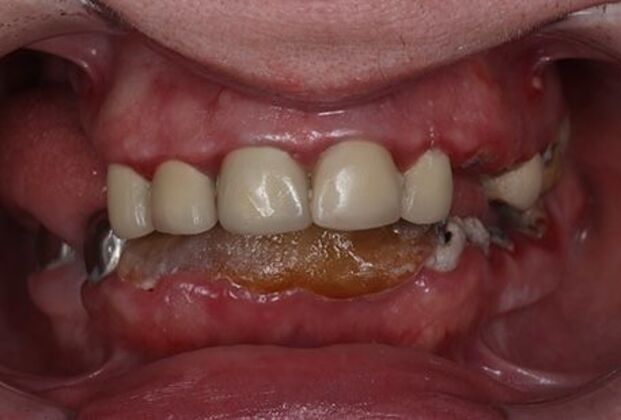 All-On-4/6: Gina Full mouth Implants - Before