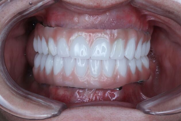 All-On-4/6: Gina Full mouth Implants - After