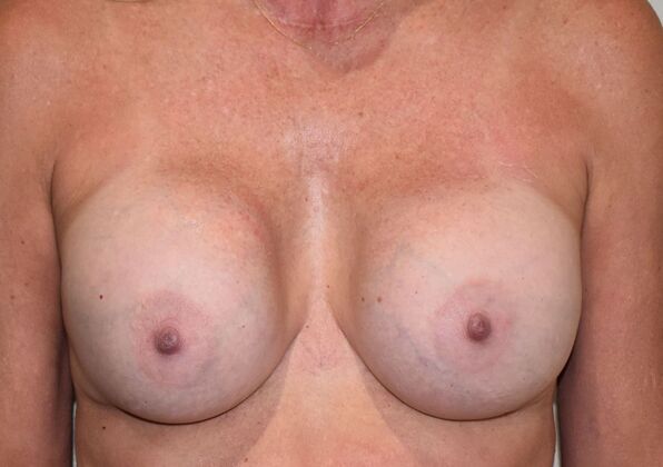 Breast Revision: Case 251 - Before