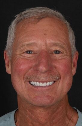 Full Mouth Restoration Deen- Zirconium crowns - After