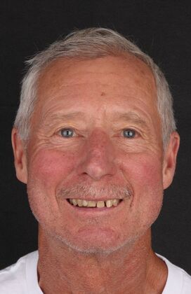 Full Mouth Restoration Deen- Zirconium crowns - Before