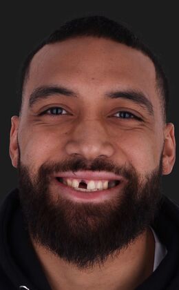 Full Mouth Restoration soccer player- Tipa  - Before