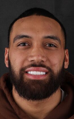 Full Mouth Restoration soccer player- Tipa  - After