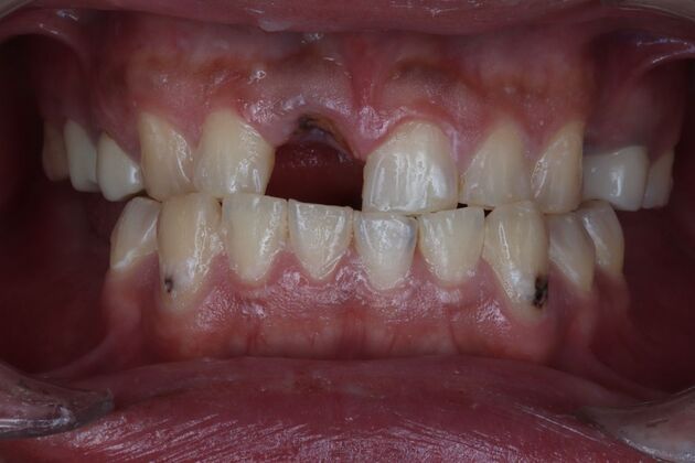 Full Mouth Restoration: soccer player- Tipa - Before