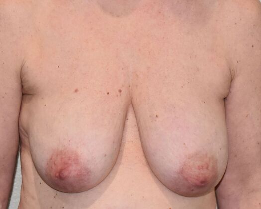 Breast Lift (Mastopexy) Case 205 - Before