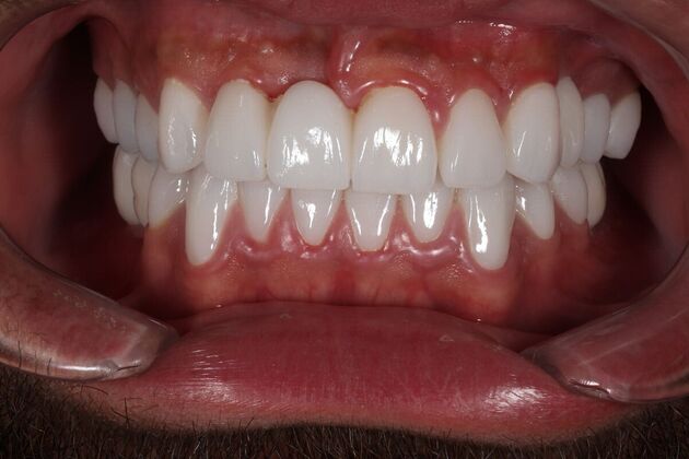 Full Mouth Restoration: soccer player- Tipa - After