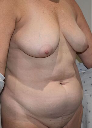 Mommy Makeover: Case 307 - Before