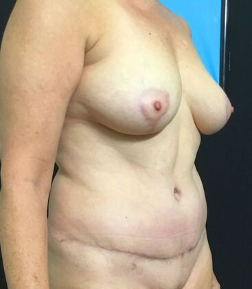 Mommy Makeover: Case 307 - After