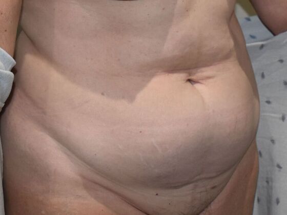 Tummy Tuck (Abdominoplasty): Case 485 - Before