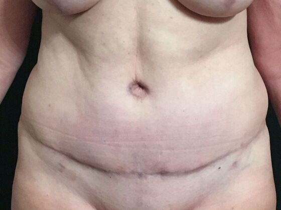 Tummy Tuck (Abdominoplasty): Case 485 - After