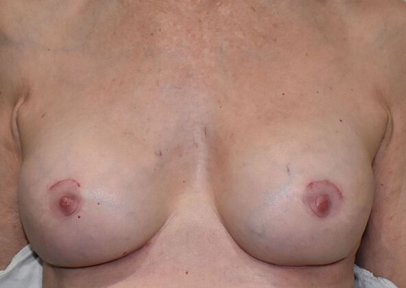 Breast Revision: Case 252 - After