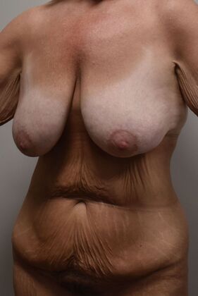 Massive Weight Loss : Case 152 - Before