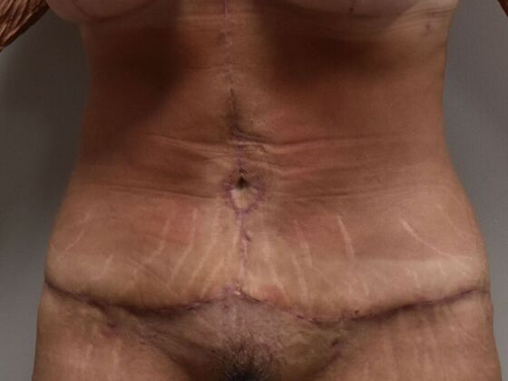 Tummy Tuck (Abdominoplasty): Case 486 - After