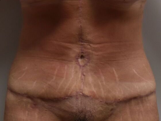 Tummy Tuck (Abdominoplasty): Case 486 - After