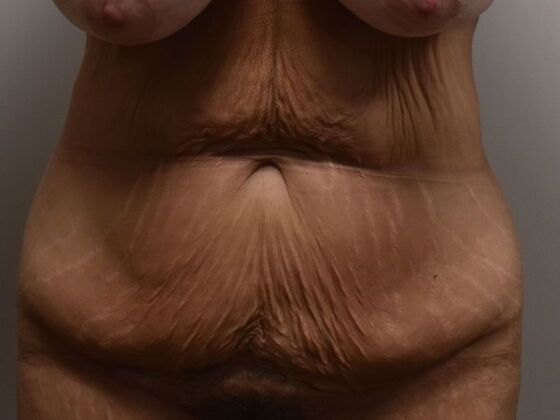 Tummy Tuck (Abdominoplasty): Case 486 - Before