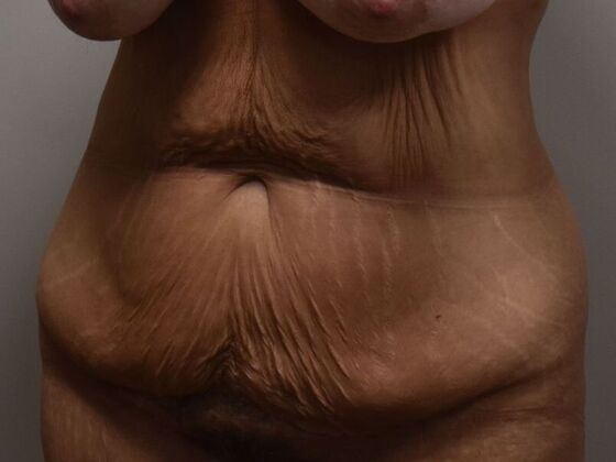 Tummy Tuck (Abdominoplasty): Case 486 - Before