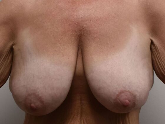 Breast Lift (Mastopexy) Case 207 - Before