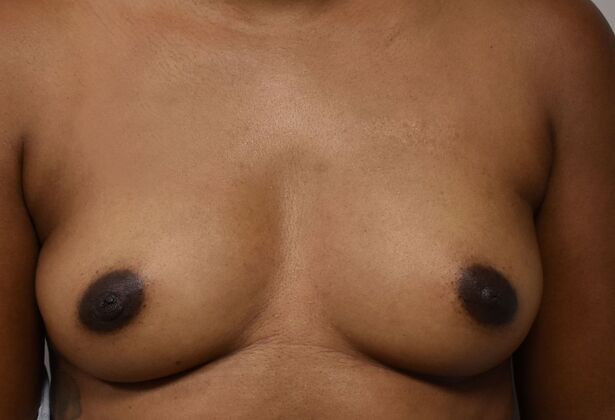 Breast Augmentation Case 764 - Before