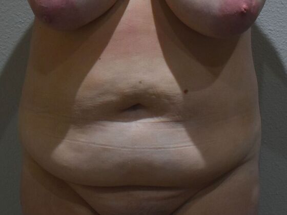 Tummy Tuck (Abdominoplasty): Case 487 - Before