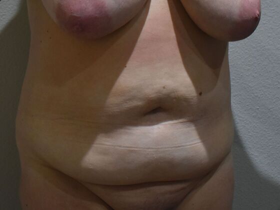 Tummy Tuck (Abdominoplasty): Case 487 - Before