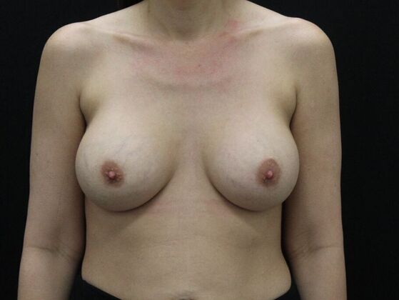Breast Augmentation Case 31 - Before