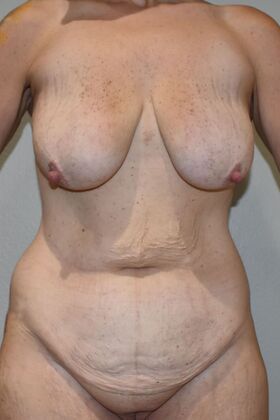 Mommy Makeover Case 310 - Before