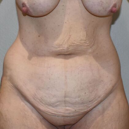 Tummy Tuck (Abdominoplasty): Case 488 - Before
