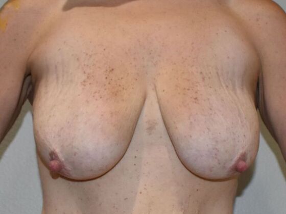 Breast Lift (Mastopexy) Case 210 - Before