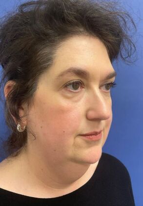 Facelift / RestoreLift Case 25 - Before