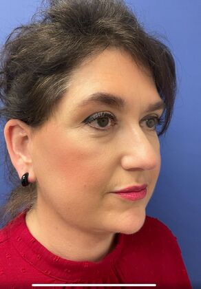 Facelift / RestoreLift Case 25 - After