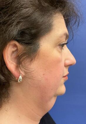 Facelift / RestoreLift: Case 25 - Before