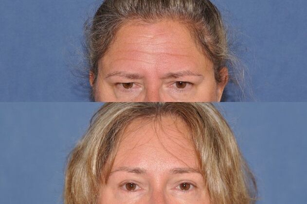 Endoscopic Browlift: Endo Browlift, upper and lower lids 1 year - Before